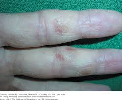 hand eczema basiccal key