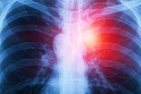 Contact a mesothelioma attorney or mesothelioma law firm if you have been diagnosed with malignant mesothelioma, or believe that you were exposed to asbestos while on the job. Mesothelioma Lawyers The Dominguez Firm