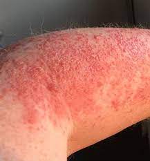 8 types of rashes that can be a sign of