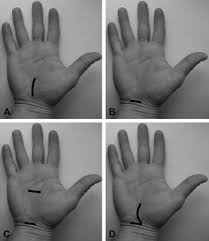 carpal tunnel surgery an overview