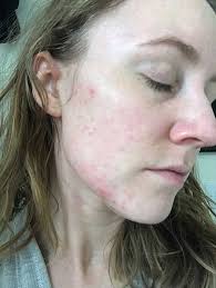cystic acne naturally