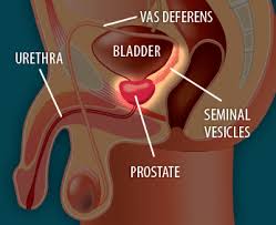 Getting a diagnosis of bladder cancer can be a difficult time. Treating Localized Prostate Cancer Effective Health Care Program