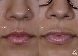 the permanent alternative to lip fillers