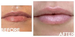 lip filler 101 the benefits pain