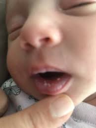 white spots on baby s lips babycenter