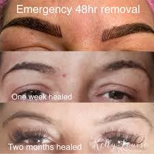 emergency brow removal wolverhton