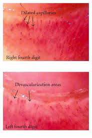 panoramic nailfold capillaroscopy of