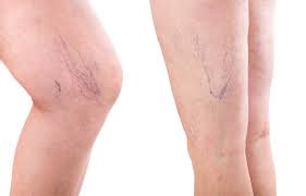 why spider vein treatment will be the