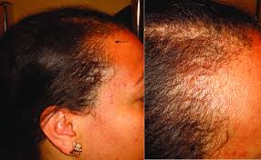 topical interferon alopecia left hair