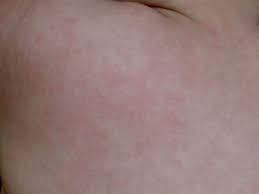 The most common causes of rash in adults are either allergic, inflammatory or hemorrhagic. Viral Rash Types Symptoms And Treatment In Adults And Babies