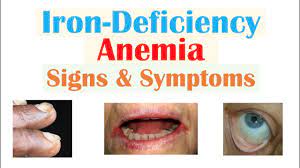 iron deficiency anemia signs symptoms