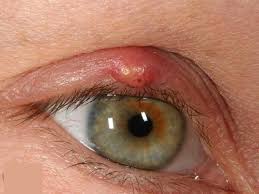 pimple on eyelid types causes how