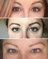 droopy inner eyelids a week after botox