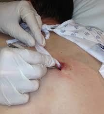 abscess incision and drainage a