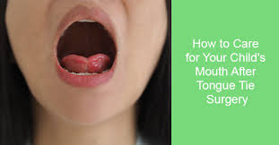 mouth after tongue tie surgery
