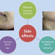 Laser hair removal over time will reduce hair growth. Side Effects Of Laser Hair Removal Download Scientific Diagram
