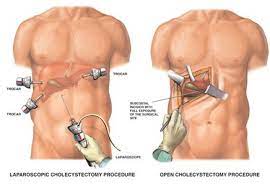 gallbladder removal surgery treatment
