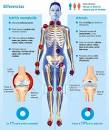 Resultado de imagen para diferencia entre artritis y artrosis