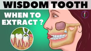 is wisdom teeth removal painful what