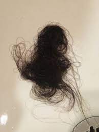 postpartum hair loss pic august