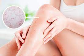 can laser hair removal treat keratosis