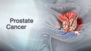 prostate cancer sing information