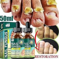 anti fungal nail infection