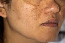 home remes for hyperpigmentation