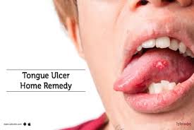 herbal effective mouth ulcer relief