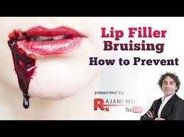 lip filler bruising how to prevent it