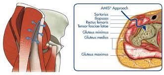 direct anterior approach