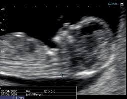 Normal 1st Trimester Ultrasound How To