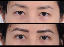 best double eyelid surgery los angeles