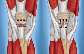 Butions to the medial and lateral heads may be. Patellar Tendon Tear Orthoinfo Aaos