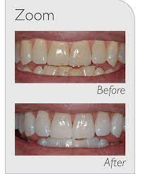 teeth whitening above beyond dental