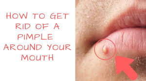 pimples around your mouth