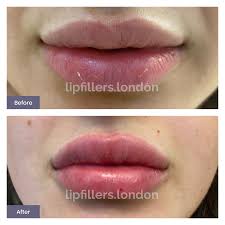 uk s no 1 lip fillers london clinic