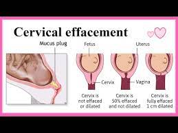 cervical effacement you