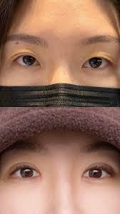 i got double eyelid surgery in korea