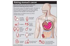 They can affect your digestion, such as lost a noticeable amount of weight over the last 6 to 12 months without trying. Stomach Cancer What Do You Need To Know Beacon Hospital