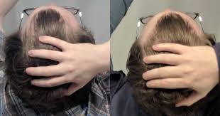 More results of hair regeneration on thinning hair: Finasteride And Microneedling 11 Month Results Hairlosstalk Forums