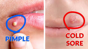 cold sores vs pimples how they look