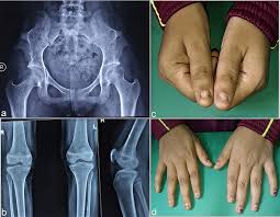 cureus nail patella syndrome a case
