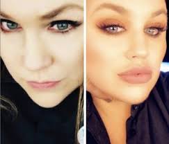 lip injections in nyc non surgical