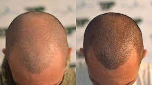 زراعة الشعر بطريقة SUT - زراعة الشعر | زراعة الشعر في ايران مشهد | مركز  زراعة شعر
