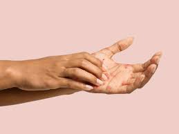 hand eczema treatment how to get rid