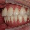 The treatment options for overbites include braces, tooth extraction, and jaw there are many factors that will assist in determining how to correct your teeth and jaw. Https Encrypted Tbn0 Gstatic Com Images Q Tbn And9gcsh0lbphpg2hdg0ksz Pi1pmjoi9uuxhsz9r4donjoe2 Hi8srx Usqp Cau