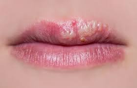 2 wochen ein kleines (ca. Fieberblase 9 Hartnackige Mythen Um Lippenherpes Minimed At