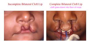 cleft lip and palate patient flashcards