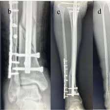 intramedullary nailing for tibial fracture